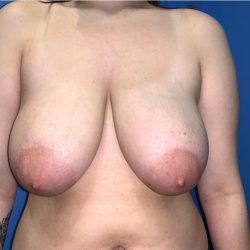 Breast Reduction Before & After Patient #19216