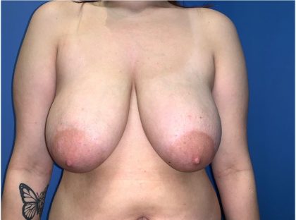 Breast Reduction Before & After Patient #19216
