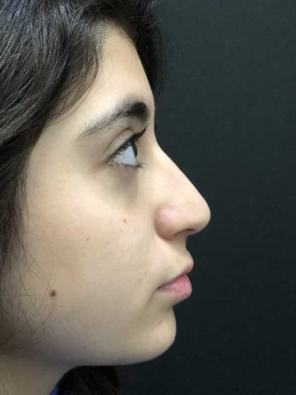 Rhinoplasty Before & After Patient #19274
