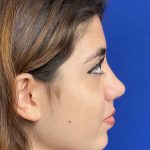 Rhinoplasty Before & After Patient #19274