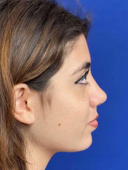 Rhinoplasty Before & After Patient #19274