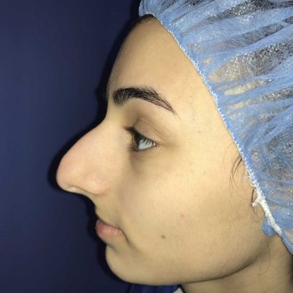 Rhinoplasty Before & After Patient #19275