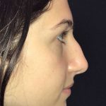 Rhinoplasty Before & After Patient #19270