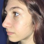 Rhinoplasty Before & After Patient #19270