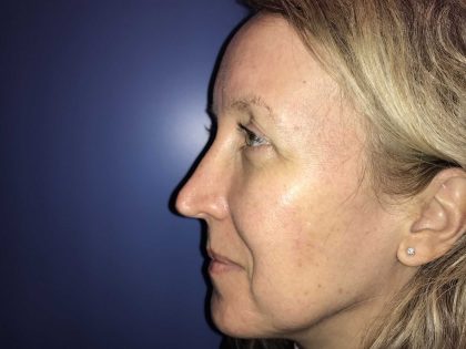 Rhinoplasty Before & After Patient #19271
