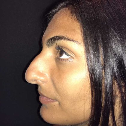 Rhinoplasty Before & After Patient #19273