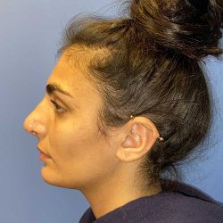 Rhinoplasty Before & After Patient #19273