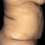 Tummy Tuck Before & After Patient #19140