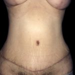 Tummy Tuck Before & After Patient #19160