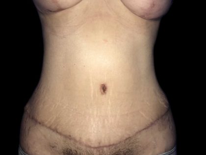 Tummy Tuck Before & After Patient #19160