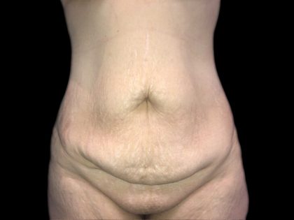 Tummy Tuck Before & After Patient #19160