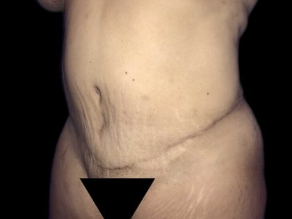 Tummy Tuck Before & After Patient #19162