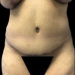 Tummy Tuck Before & After Patient #19234