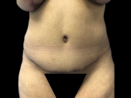 Tummy Tuck Before & After Patient #19234