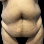 Tummy Tuck Before & After Patient #19234