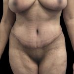 Tummy Tuck Before & After Patient #19247