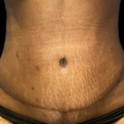 Tummy Tuck Before & After Patient #19249