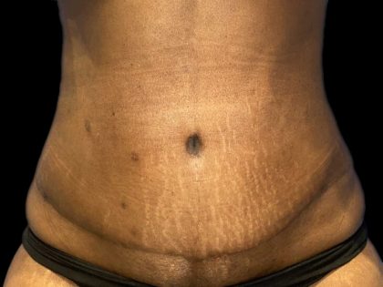 Tummy Tuck Before & After Patient #19249