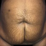 Tummy Tuck Before & After Patient #19249