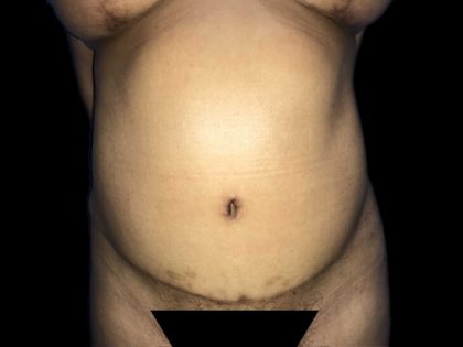 Tummy Tuck Before & After Patient #19251