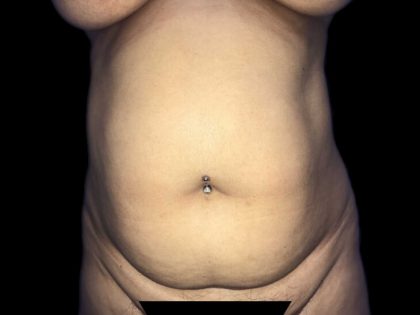 Tummy Tuck Before & After Patient #19251