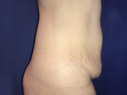 Tummy Tuck Before & After Patient #19236