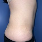 Tummy Tuck Before & After Patient #19236