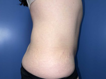 Tummy Tuck Before & After Patient #19236