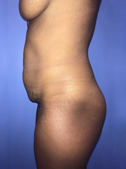Tummy Tuck Before & After Patient #19248