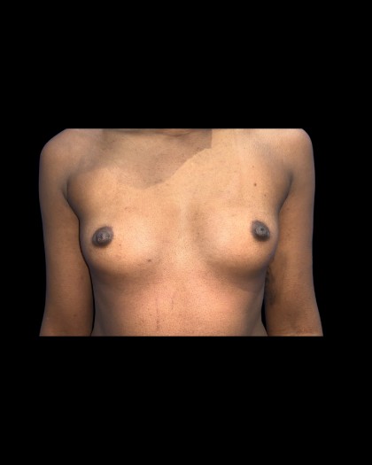Breast Augmentation Before & After Patient #21342