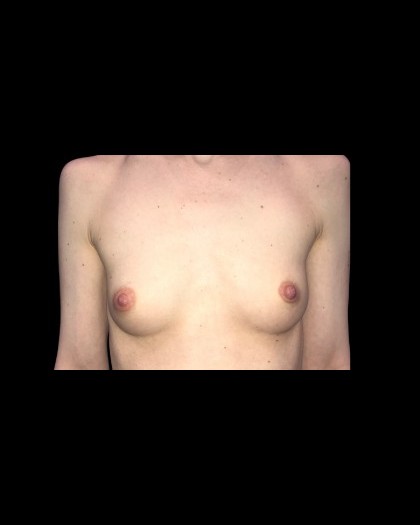 Breast Augmentation Before & After Patient #21585