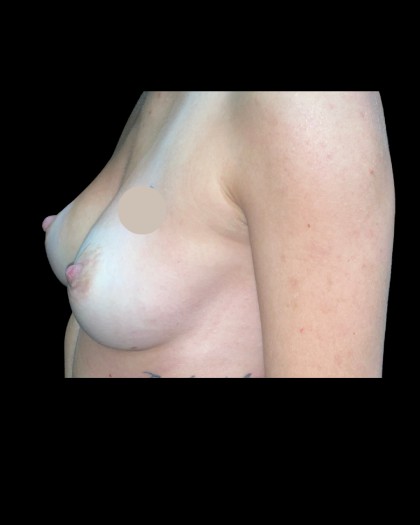 Breast Augmentation Before & After Patient #21330