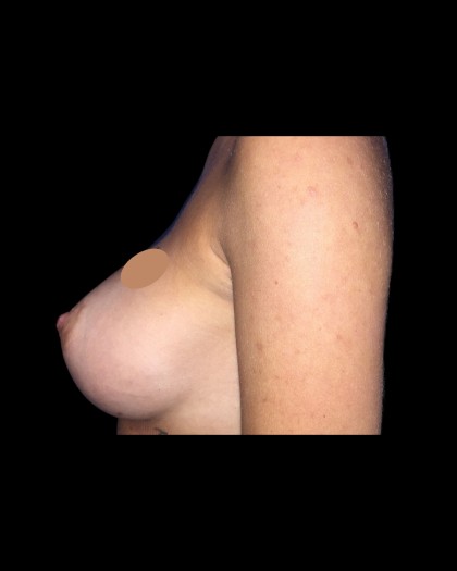 Breast Augmentation Before & After Patient #21330