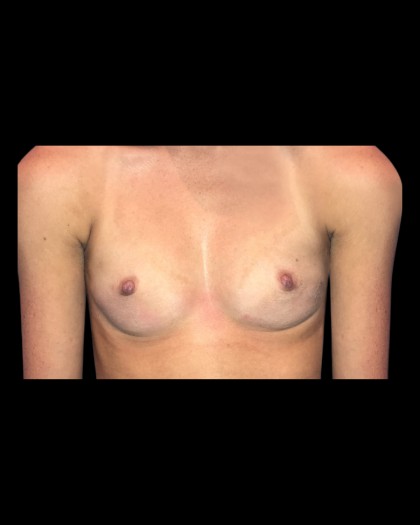 Breast Augmentation Before & After Patient #21326