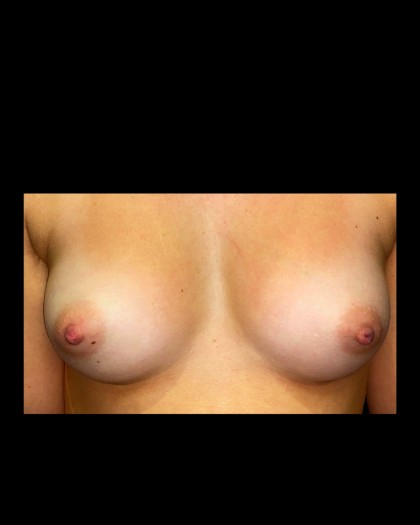 Breast Augmentation Before & After Patient #21332