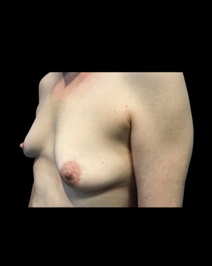 Breast Augmentation Before & After Patient #21334