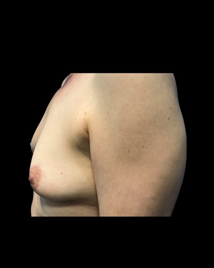 Breast Augmentation Before & After Patient #21334