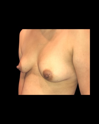 Breast Augmentation Before & After Patient #21336