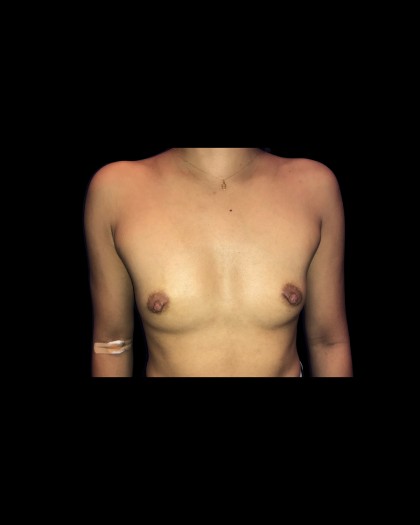 Breast Augmentation Before & After Patient #21338