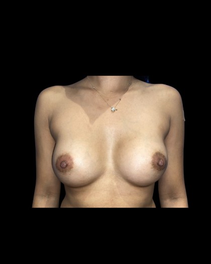 Breast Augmentation Before & After Patient #21338