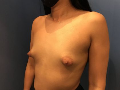 Breast Augmentation Before & After Patient #21388