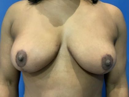 Breast Lift Before & After Patient #21376