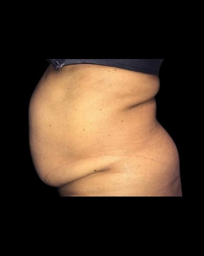Tummy Tuck Before & After Patient #21279