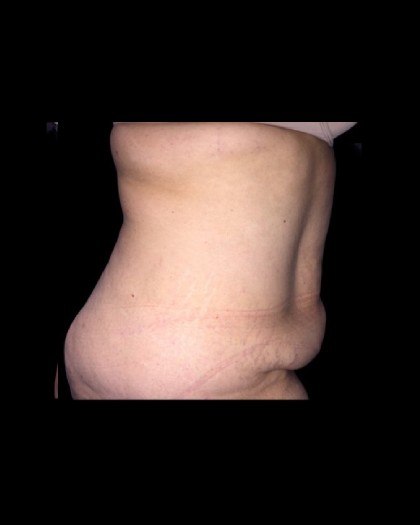 Tummy Tuck Before & After Patient #21269