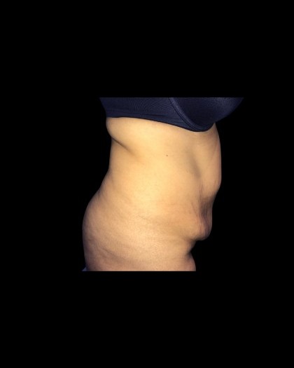 Tummy Tuck Before & After Patient #21271