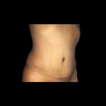 Tummy Tuck Before & After Patient #21280