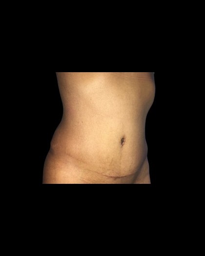 Tummy Tuck Before & After Patient #21280