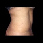 Tummy Tuck Before & After Patient #21269