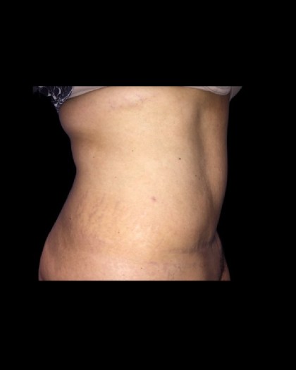 Tummy Tuck Before & After Patient #21269