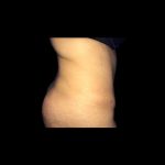 Tummy Tuck Before & After Patient #21271